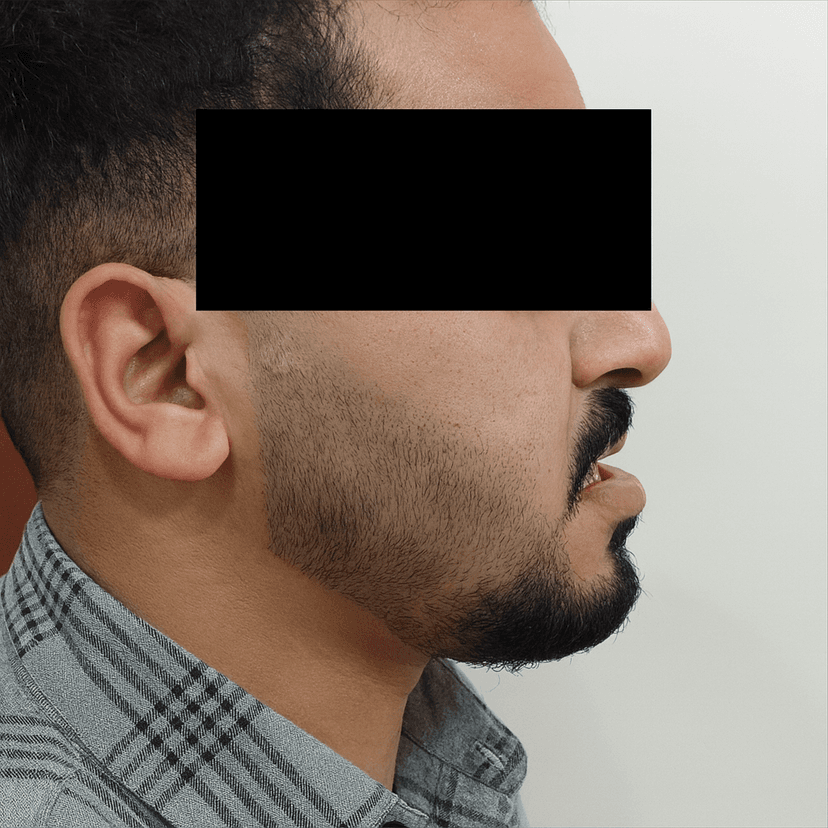 Cleft lip and palate